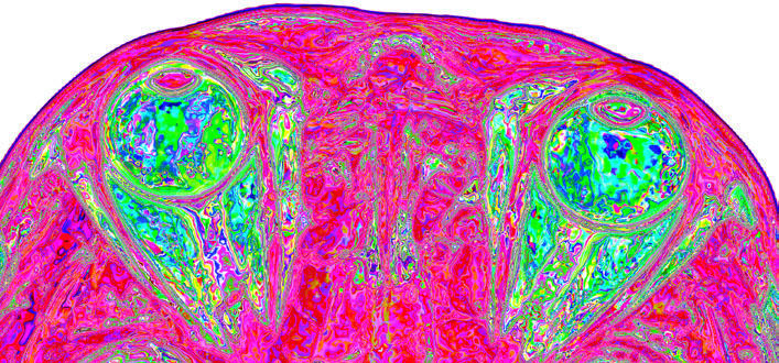 MRI scan of the eyes and parts of the brain